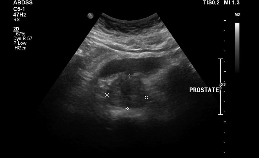 Ultrazvočni prostatitis pred jemanjem Urosaf
