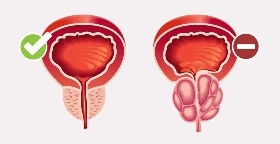 Prostatitis pri moških
