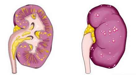 Kaj je akutni prostatitis, ki vodi