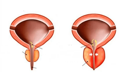 Kaj je akutni prostatitis