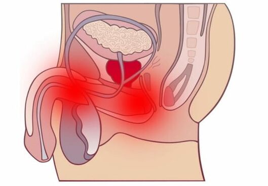Akutni prostatitis