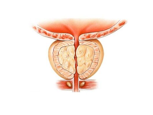Povečana prostata s prostatitisom